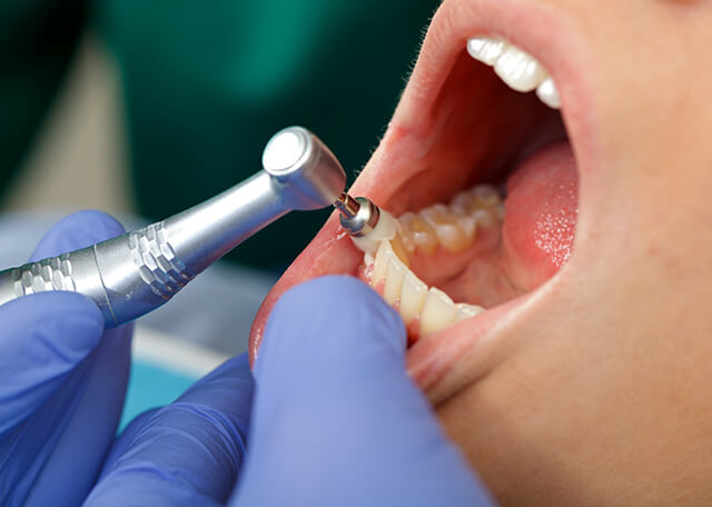PMCT(歯のクリーニング)
