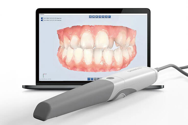 口腔内3Dスキャナー